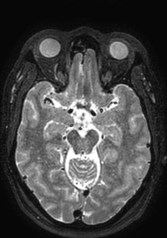 Accessory middle cerebral artery (Radiopaedia 73114-83828 Axial T2 117).jpg
