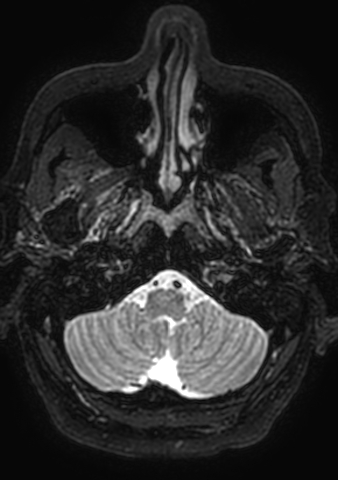 Accessory middle cerebral artery (Radiopaedia 73114-83828 Axial T2 201).jpg