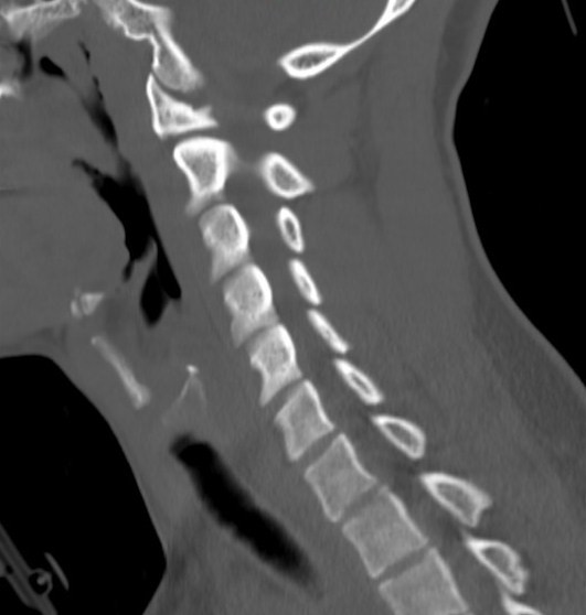 File:Accessory ossicle of the anterior arch of C1 vertebra (Radiopaedia 58149-65211 Sagittal bone window 12).jpg