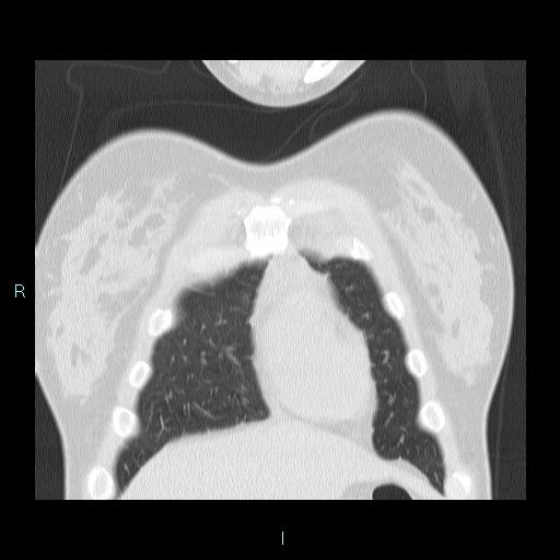 Accidental foreign body aspiration (seamstress needle) (Radiopaedia 77740-89983 Coronal lung window 56).jpg