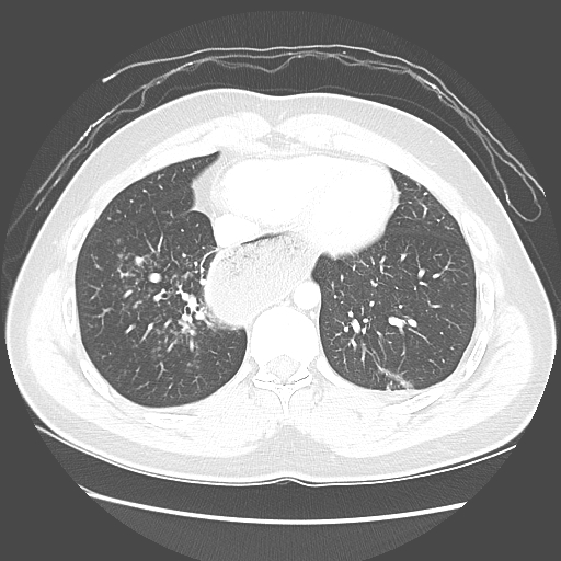 Achalasia (Radiopaedia 52507-58417 Axial lung window 46).jpg