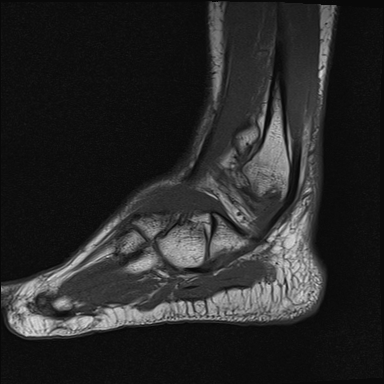 File:Achilles tendon tear (Radiopaedia 77615-89819 Sagittal T1 18).jpg