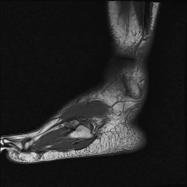 File:Achilles tendon tear (Radiopaedia 77615-89819 Sagittal T1 21).jpg