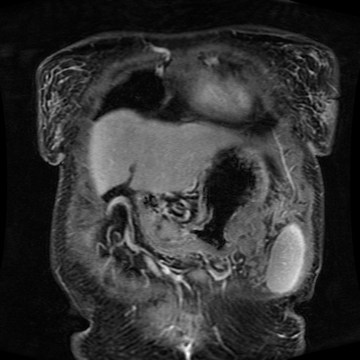Acinar cell carcinoma of the pancreas (Radiopaedia 75442-86668 Coronal T1 C+ fat sat 156).jpg