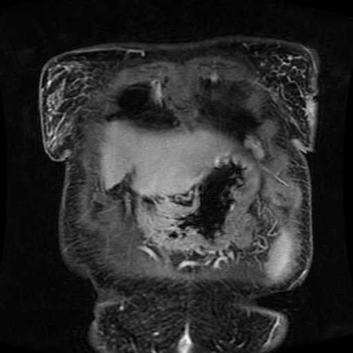 Acinar cell carcinoma of the pancreas (Radiopaedia 75442-86668 Coronal T1 C+ fat sat 163).jpg