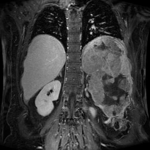 Acinar cell carcinoma of the pancreas (Radiopaedia 75442-86668 Coronal T1 C+ fat sat 59).jpg