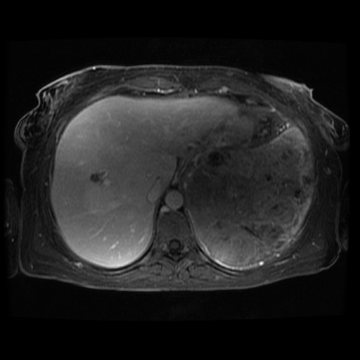 Acinar cell carcinoma of the pancreas (Radiopaedia 75442-86668 D 111).jpg