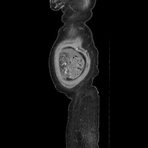Acinar cell carcinoma of the pancreas (Radiopaedia 75442-86669 Sagittal C+ portal venous phase 182).jpg