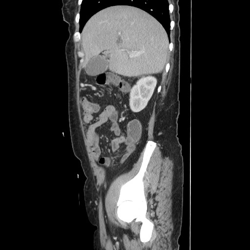File:Acinar cell carcinoma of the pancreas (Radiopaedia 75442-86669 Sagittal C+ portal venous phase 58).jpg