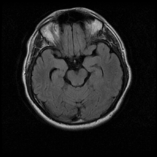 File:Acoustic schwannoma (Radiopaedia 33045-34060 Axial FLAIR 8).png