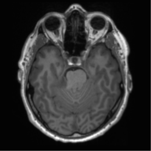 File:Acoustic schwannoma (Radiopaedia 50846-56358 Axial T1 35).png