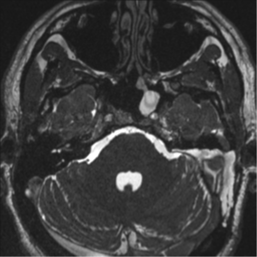 Acoustic schwannoma (translabyrinthine resection) (Radiopaedia 43570-46972 Axial CISS 32).png