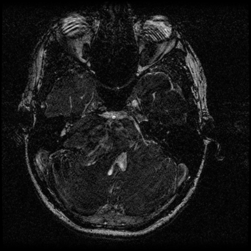 Acoustic schwannoma - eroding petrous apex (Radiopaedia 39674-42004 Axial T2 42).png