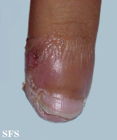 Acrodermatitis Continua (Dermatology Atlas 2).jpg
