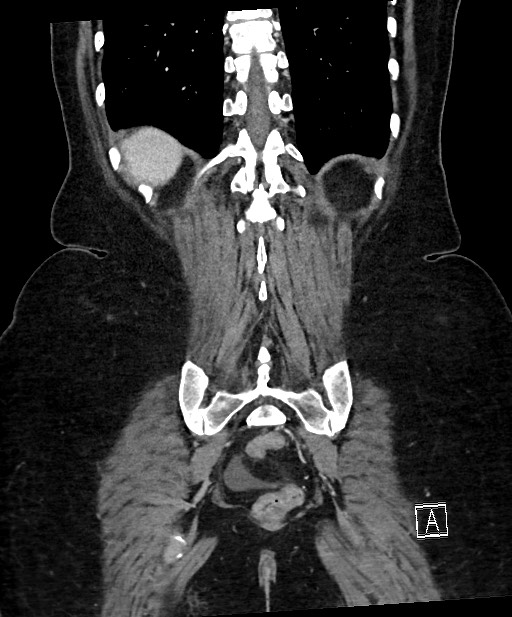 Active Crohn disease (Radiopaedia 59394-66750 Coronal C+ portal venous phase 57).jpg