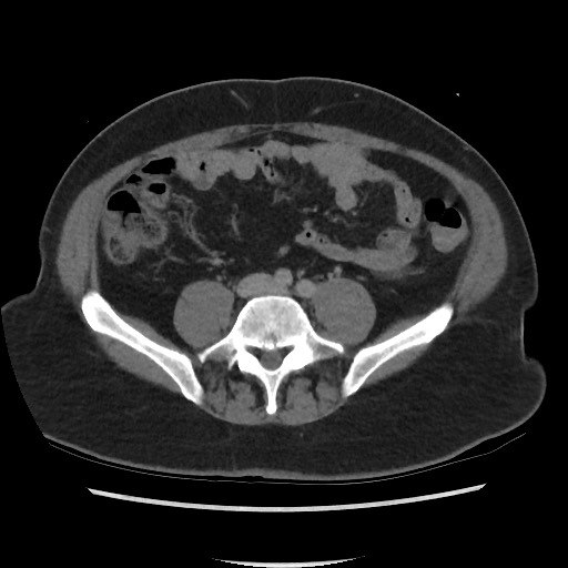 File:Active colonic bleed on CT (Radiopaedia 49765-55025 Axial C+ delayed 54).jpg