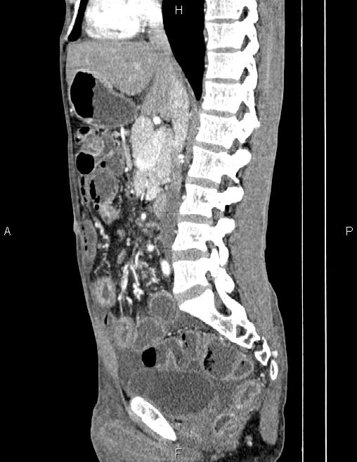 Active crohn disease (Radiopaedia 87133-103397 Sagittal C+ arterial phase 41).jpg