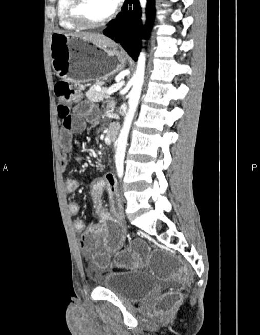 Active crohn disease (Radiopaedia 87133-103397 Sagittal C+ arterial phase 51).jpg