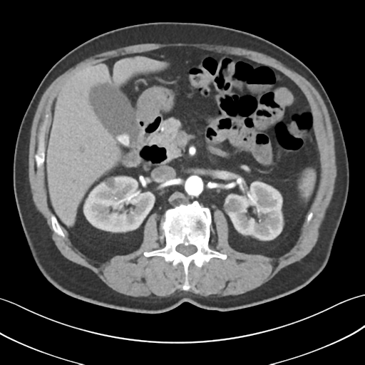 Active diverticular hemorrhage (Radiopaedia 39415-41725 Axial C+ arterial phase 23).png