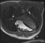 File:Active right ventricular cardiac sarcoidosis (Radiopaedia 55596-62100 Axial Dynamic perfusion scan MOCO 56).jpg
