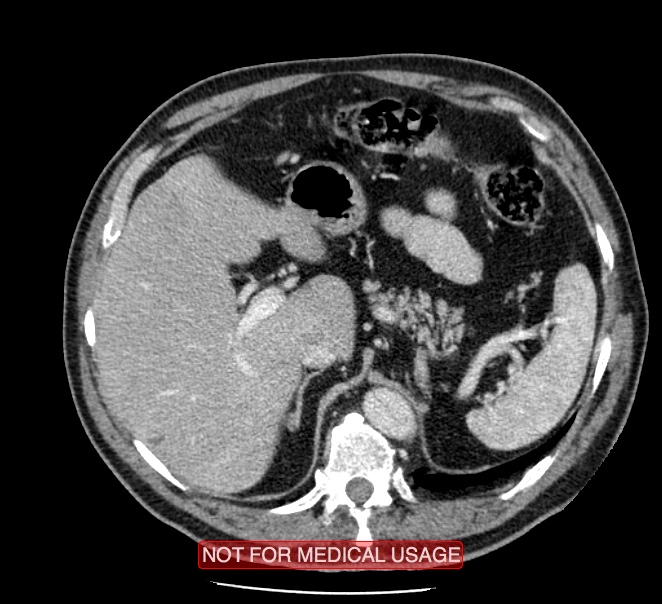 Acute aortic dissection - Stanford type A (Radiopaedia 40661-43285 Axial C+ portal venous phase 71).jpg