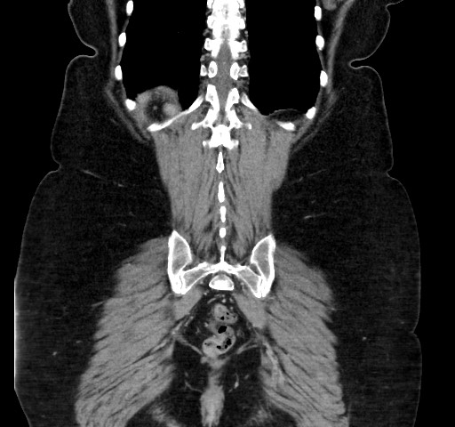 Acute appendicitis, heterotaxy syndrome (Radiopaedia 66884-76202 Coronal C+ portal venous phase 103).jpg
