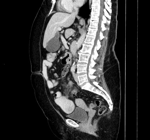 Acute appendicitis, heterotaxy syndrome (Radiopaedia 66884-76202 Sagittal C+ portal venous phase 71).jpg