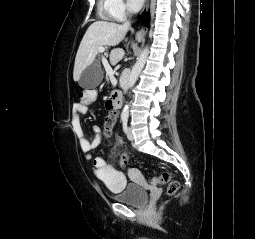 File:Acute appendicitis, heterotaxy syndrome (Radiopaedia 66884-76202 Sagittal C+ portal venous phase 72).jpg