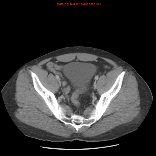 Acute appendicitis (Radiopaedia 10498-10973 Axial C+ portal venous phase 43).jpg