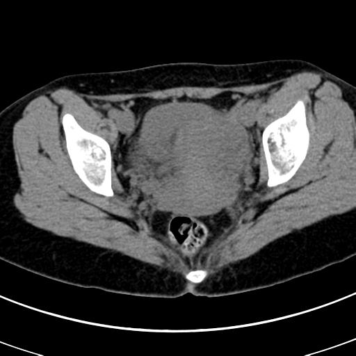 Acute appendicitis (Radiopaedia 30261-30888 Axial non-contrast 96).jpg