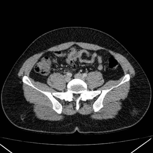 Acute appendicitis (Radiopaedia 38255-40270 Axial C+ portal venous phase 75).jpg