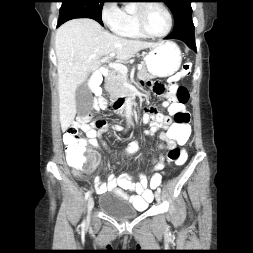 Acute appendicitis (Radiopaedia 52672-58589 Coronal C+ portal venous phase 30).jpg