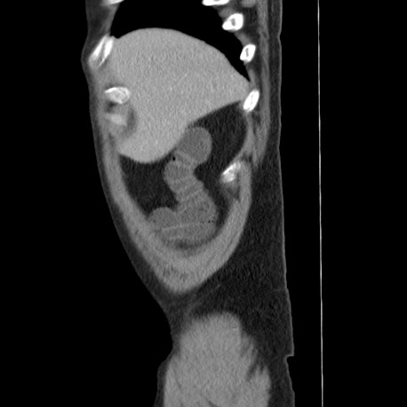 Acute appendicitis (Radiopaedia 66513-75790 Sagittal C+ portal venous phase 9).jpg