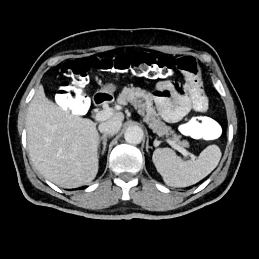 Acute appendicitis (Radiopaedia 77016-88960 Axial C+ portal venous phase 41).jpg