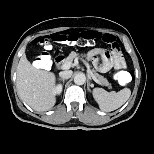 File:Acute appendicitis (Radiopaedia 77016-88960 Axial C+ portal venous phase 44).jpg