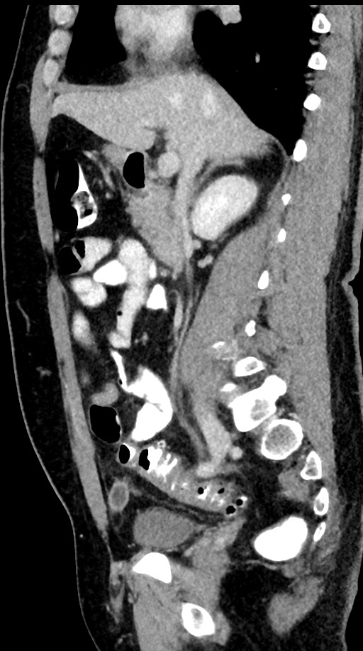 Acute appendicitis (Radiopaedia 77016-88960 Sagittal C+ portal venous phase 69).jpg