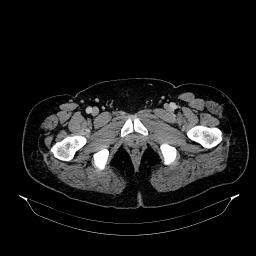 Acute appendicitis (Radiopaedia 79950-93224 Axial C+ portal venous phase 104).jpg