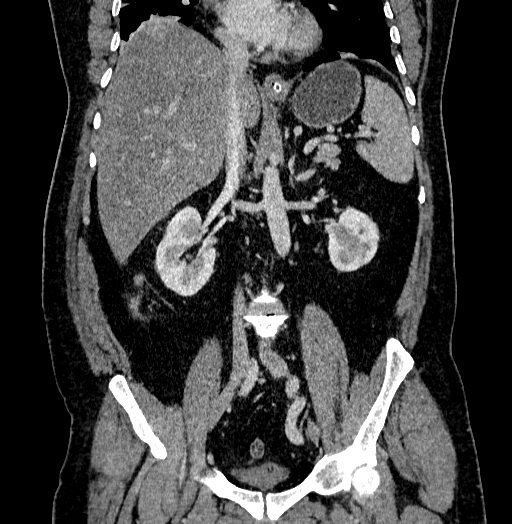 Acute appendicitis (Radiopaedia 79950-93224 Coronal C+ portal venous phase 51).jpg