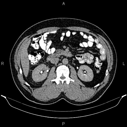 File:Acute appendicitis (Radiopaedia 84780-100240 Axial C+ delayed 44).jpg