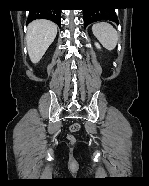 Acute appendicitis - large appendicoliths (Radiopaedia 61805-69820 Coronal C+ portal venous phase 107).jpg