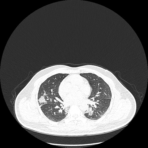 Acute appendicitis and COVID 19 pneumonia (Radiopaedia 76604-88380 Axial lung window 29).jpg