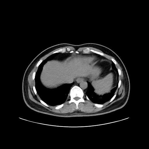 Acute appendicitis and COVID 19 pneumonia (Radiopaedia 76604-88380 Axial non-contrast 46).jpg