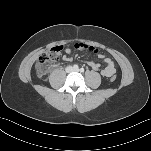 File:Acute appendicitis with appendicoliths (Radiopaedia 50186-55532 Axial C+ portal venous phase 48).png