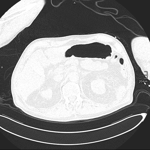 Acute aspiration pneumonitis (Radiopaedia 55642-62166 Axial lung window 159).jpg
