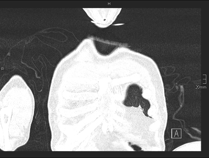 Acute aspiration pneumonitis (Radiopaedia 55642-62166 Coronal lung window 7).jpg