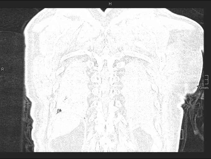 File:Acute aspiration pneumonitis (Radiopaedia 55642-62166 Coronal lung window 93).jpg