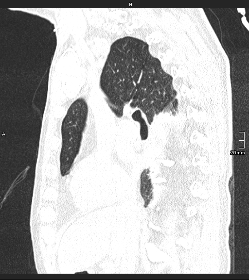 File:Acute aspiration pneumonitis (Radiopaedia 55642-62166 Sagittal lung window 92).jpg
