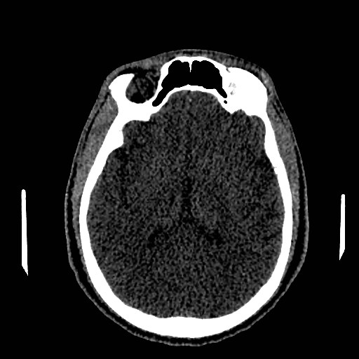 File:Acute basilar artery occlusion (Radiopaedia 43582-46985 Axial non-contrast 98).jpg