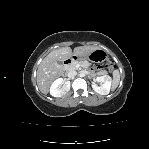 Acute bilateral pyelonephritis (Radiopaedia 37146-38881 Axial C+ portal venous phase 37).jpg
