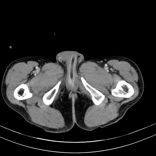 Acute bowel ischemia (Radiopaedia 87695-104114 Axial C+ portal venous phase 93).jpg